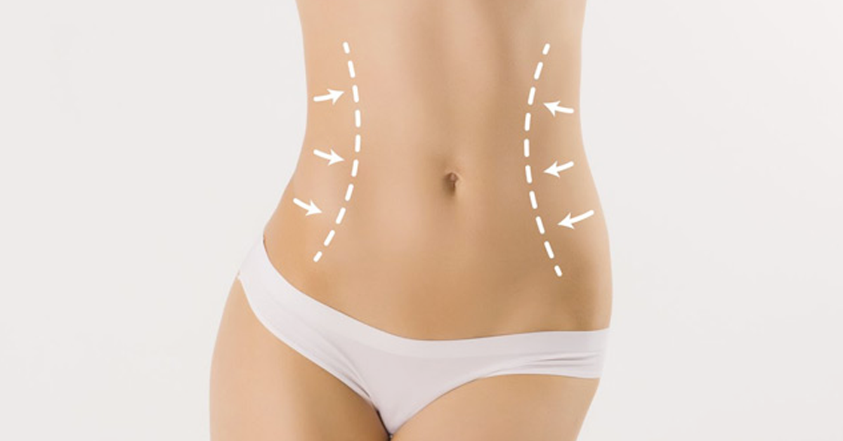 abdominoplastie prix