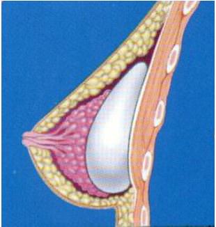  Implant sous glandulaire