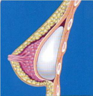  Implant sous musculaire